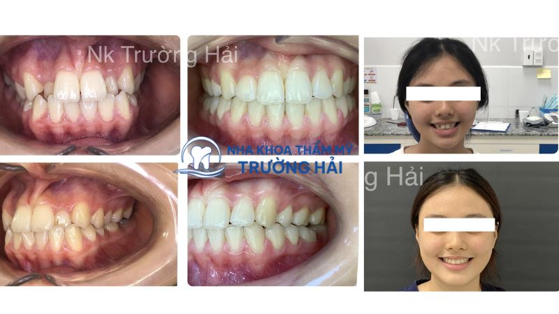 Các vấn đề đến răng miệng nên đến nha khoa thẩm mỹ