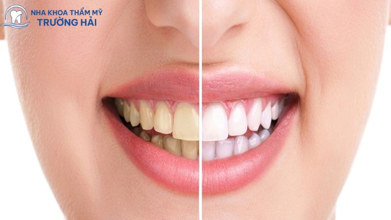 Nhiều nguyên nhân khiên răng của bạn bị nhuốm màu 