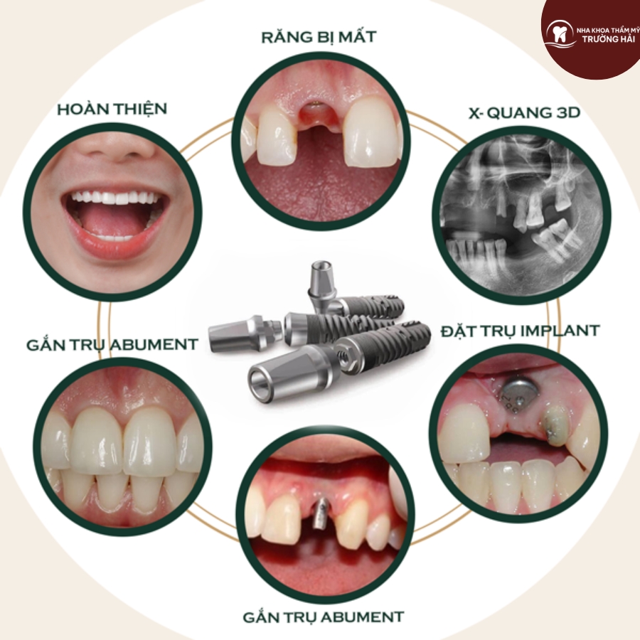 Quy trình trồng răng implant tại nha khoa Trường Hải