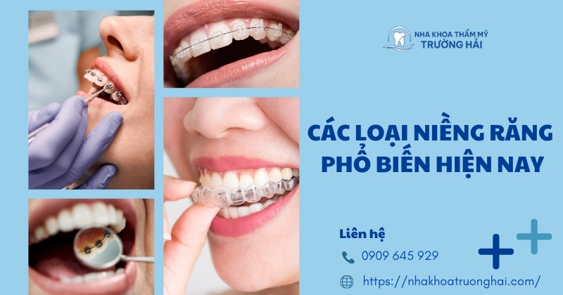 Các loại niềng răng phổ biến hiện nay