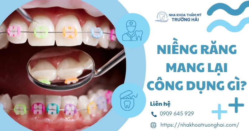 Niềng răng mang lại công dụng gì?