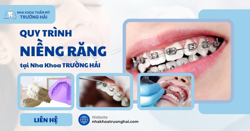 Quy trình niềng răng tại Nha khoa Trường Hải