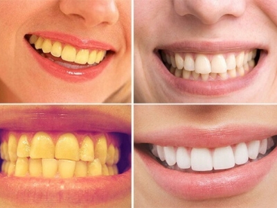 Khắc phục tình trạng răng nhuốm màu