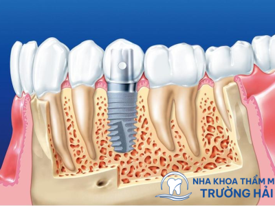 Trồng răng Implant 